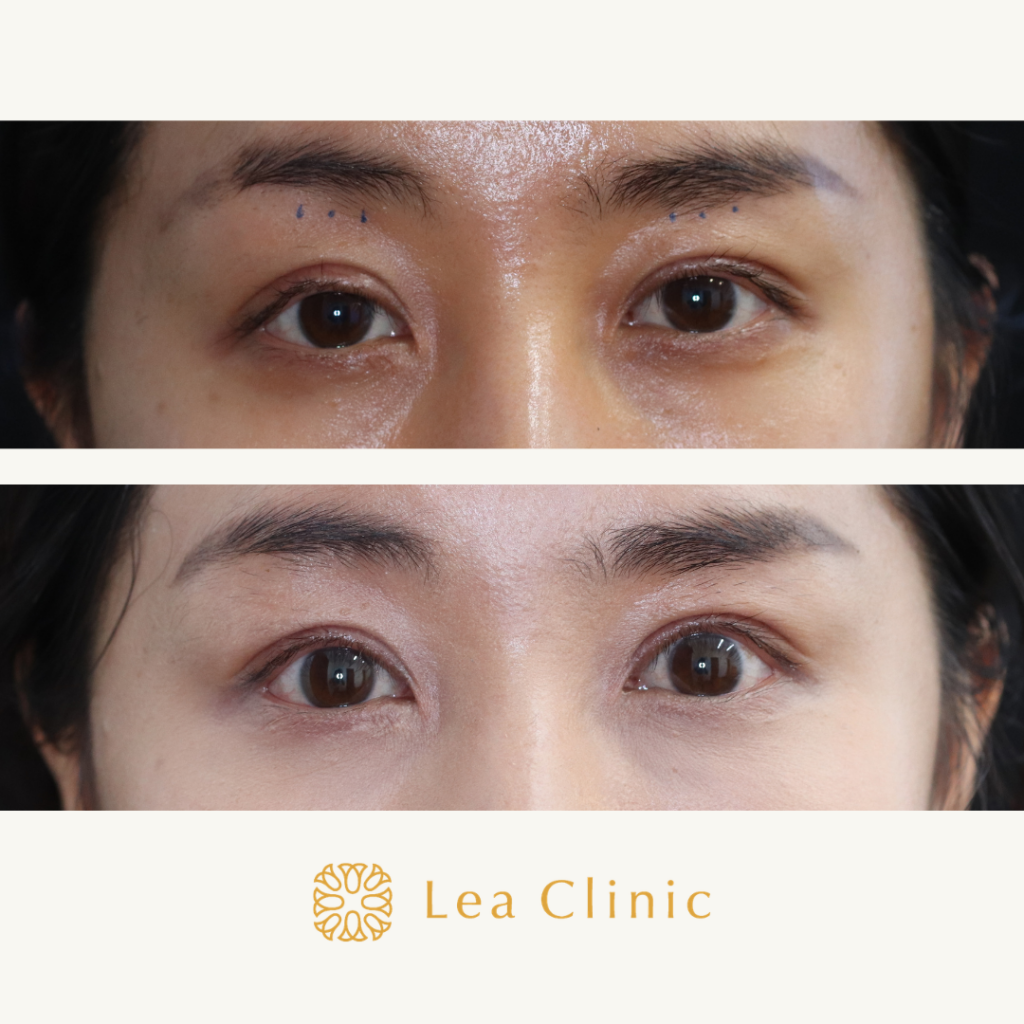 いつも眠そうな目の印象を治したい レア形成外科 美容皮膚科 Lea Clinic